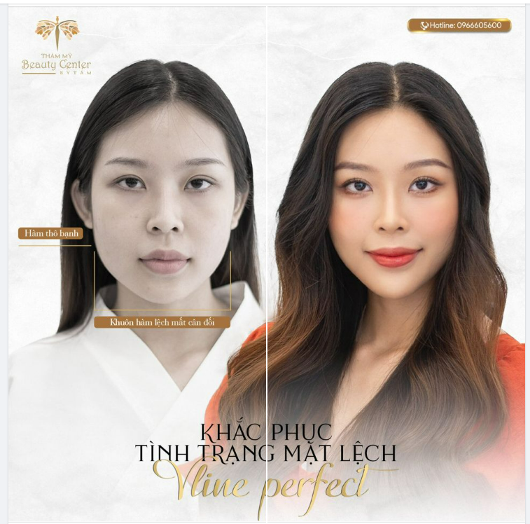 COMBO LÊN HƯƠNG NHAN SẮC - Chỉ duy nhất một lần thực hiện THON GỌN HÀM VLINE PERFECT