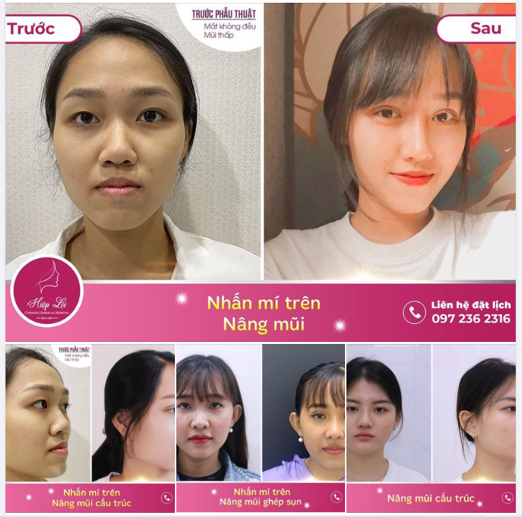 COMBO MŨI - MẮT, ĐẸP TRONG TÍC TẮC