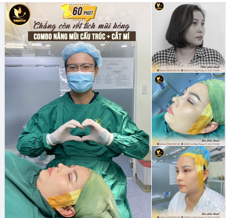 COMBO NÂNG MŨI CẤU TRÚC + CẮT MÍ VỪA THỰC HIỆN XONG MÍ RÕ NẾP, CHẲNG CÒN VẾT TÍCH MŨI HỎNG