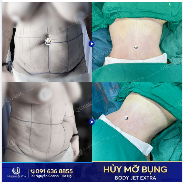 Đã bao giờ bạn lắng nghe chiếc bụng toàn m ỡ là m ỡ của mình nói gì hay chưa