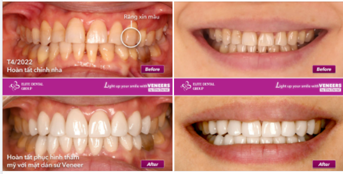 Dán sứ Veneer sau chỉnh nha - Cải thiện màu răng cho nụ cười hoàn hảo