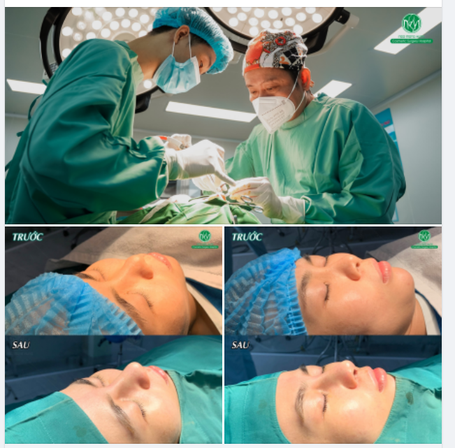 DÁNG MŨI MEGADERM ĐẸP NGAY SAU PHẪU THUẬT
