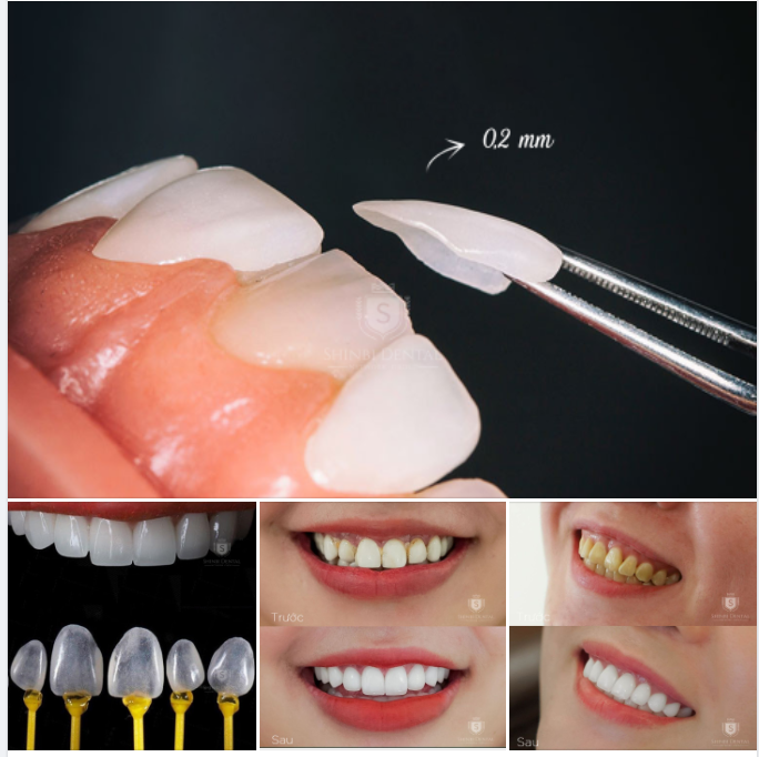 Dáng vóc mỏng manh của răng sứ Veneer , " Tuy nhỏ mà có võ"