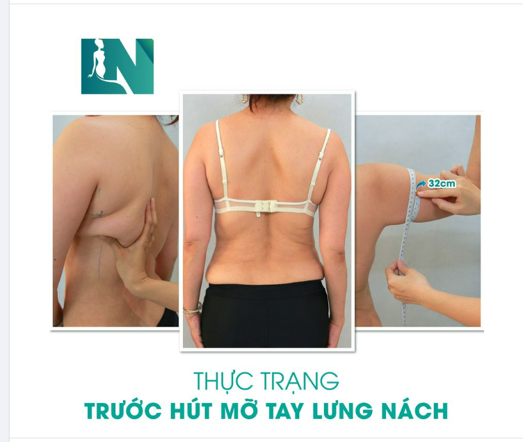 DÁNG VÓC THANH THOÁT MỀM MẠI VỚI LỰA CHỌN HÚT MỠ TAY LƯNG NÁCH CỦA CHỊ KH U60