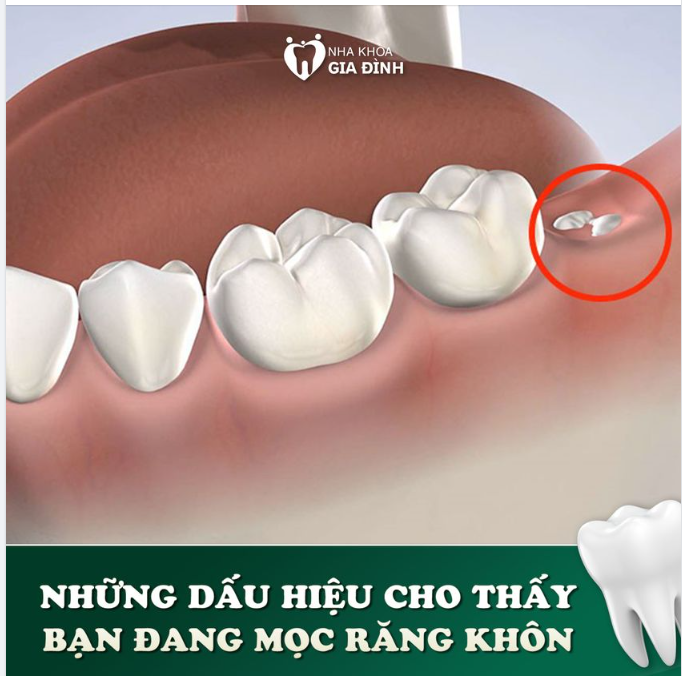 DẤU HIỆU CHO THẤY BẠN ĐANG MỌC RĂNG KHÔN