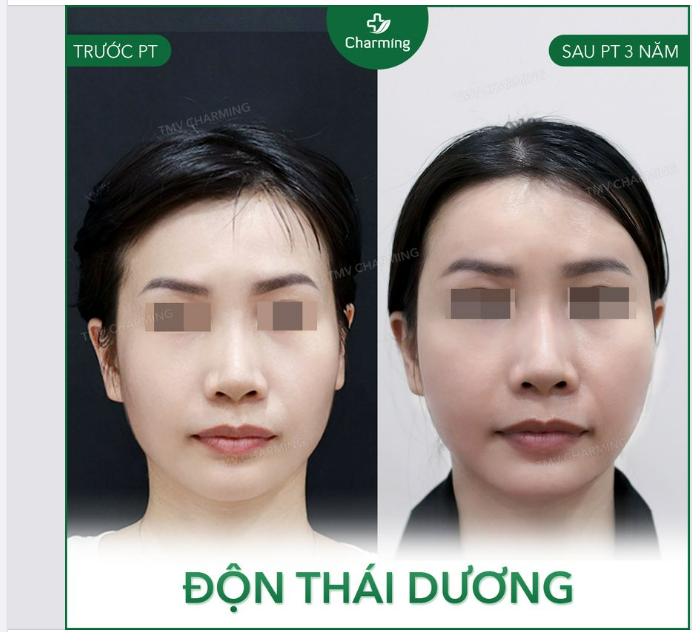 Dấu hiệu của tuổi tác sẽ đến với chúng ta qua nhiều biểu hiện, một trong số đó là độ lõm dần đều theo thời gian của hai bên thái dương.