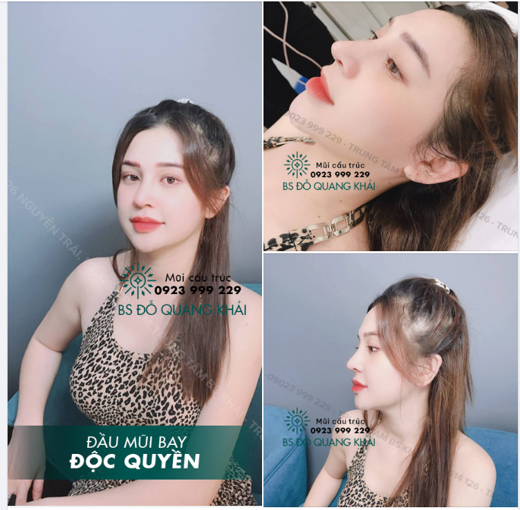 ĐẦU MŨI BAY - THON GỌN ĐỘC QUYỀN BÁC SĨ KHẢI