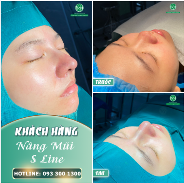 ĐÂY CÓ PHẢI DÁNG MŨI MÀ CHỊ EM MONG MUỐN