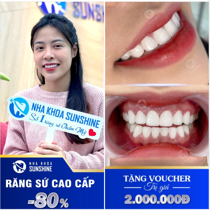 ĐẾM NGƯỢC CÒN 4 NGÀY SỞ HỮU ƯU ĐÃI LÀM RĂNG SỨ LÊN ĐẾN 80% TẠI SUNSHINE