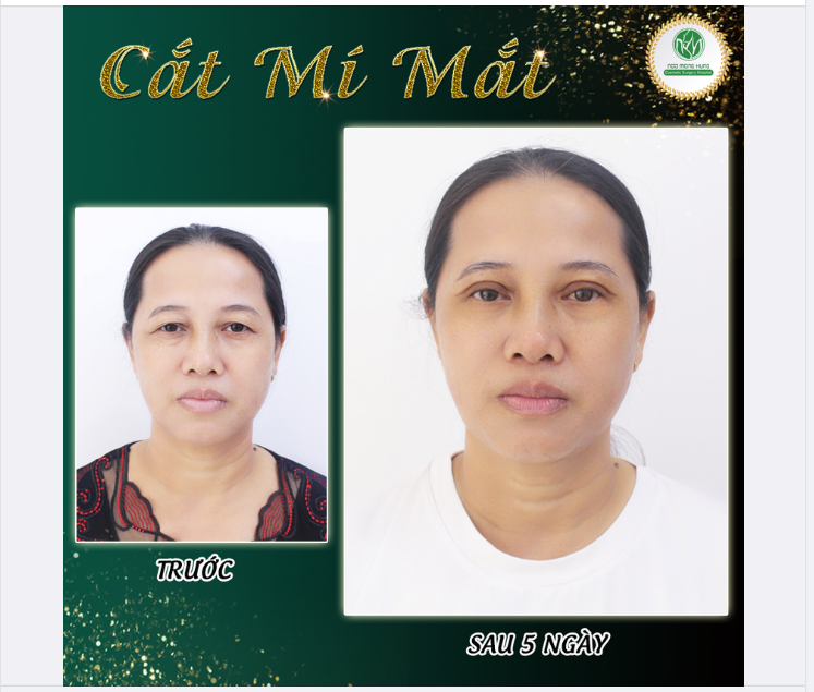 ĐẾN BVTM NGÔ MỘNG HÙNG - ĐÁNH BAY SỤP MÍ LÃO HÓA