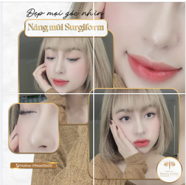 Đẹp mọi góc nhìn không gì khác chính xác là mũi Surgiform