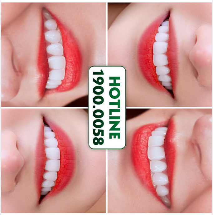 ĐẸP THẾ NÀY BẢO SAO KHÁCH ĐẾN NHA KHOA GIA ĐÌNH LÀM RĂNG THẨM MỸ NGÀY CÀNG NHIỀU
