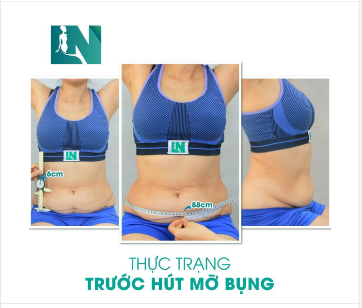 ĐẸP TOÀN DIỆN VỚI HÚT MỠ TẠO DÁNG THẨM MỸ KẾT HỢP CẤY MỠ NGỰC, TRẺ HÓA KHUÔN MẶT CHO CHỊ KH SN 1974; 