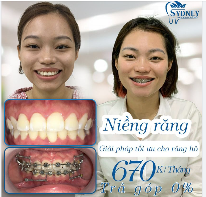 DI CHUYỂN RĂNG CHUẨN XÁC, ĐÚNG LỘ TRÌNH