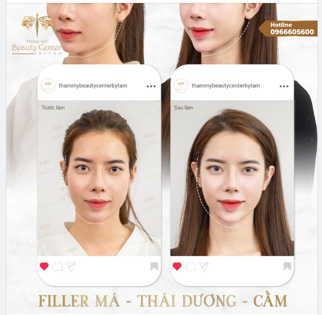 DIỆN MẠO TRẺ TRUNG XINH ĐẸP CÙNG FILLER MÁ - THÁI DƯƠNG - CẰM