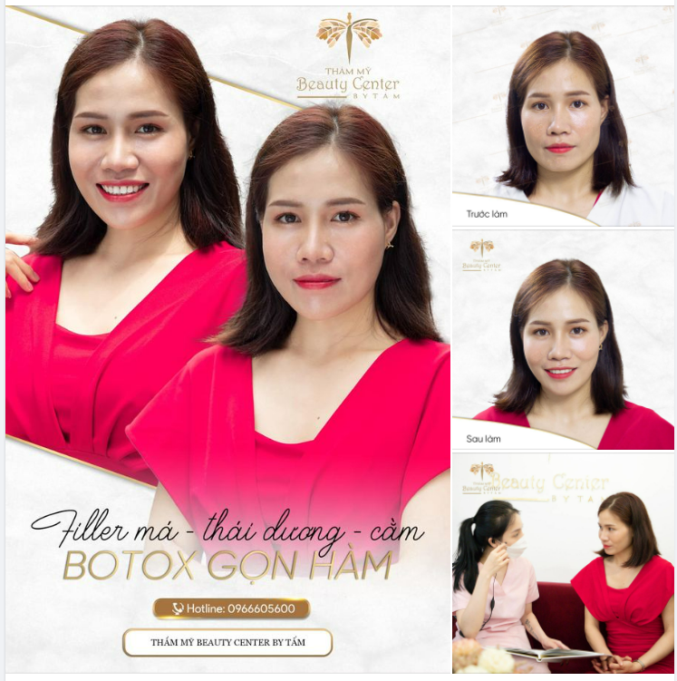 DIỆN MẠO TƯƠI TRẺ CÙNG COMBO FILLER MÁ - THÁI DƯƠNG -CẰM VÀ BOTOX GỌN HÀM TẠI TẤM