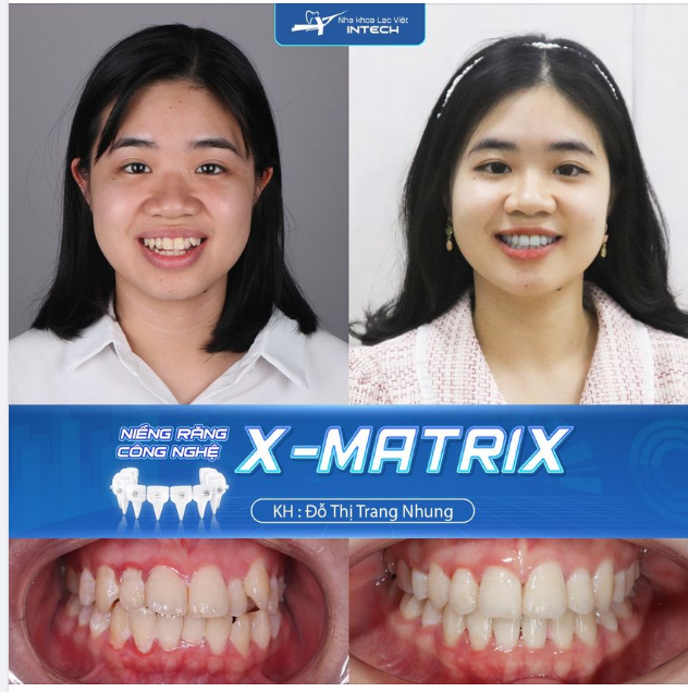 ĐIỀU TRỊ RĂNG HÔ, CHEN CHÚC VỚI CÔNG NGHỆ ĐỘC QUYỀN X-MATRIX TẠI LẠC VIỆT HITECH
