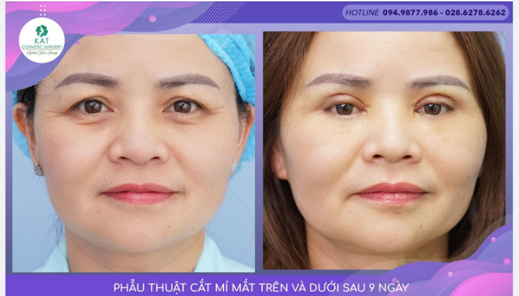 Đôi mắt luôn được xem là một bộ phận quan trọng nhất của gương mặt hay còn được ví von chính là cửa sổ tâm hồn của mỗi người.