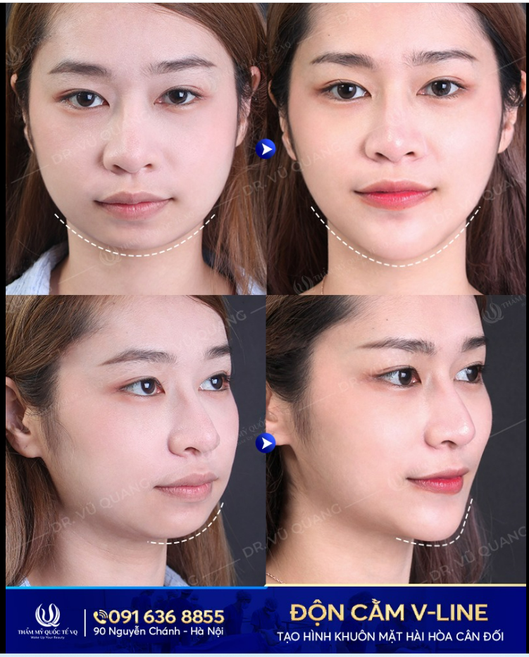 Độn cằm sau bao lâu thì phục hồi hoàn toàn