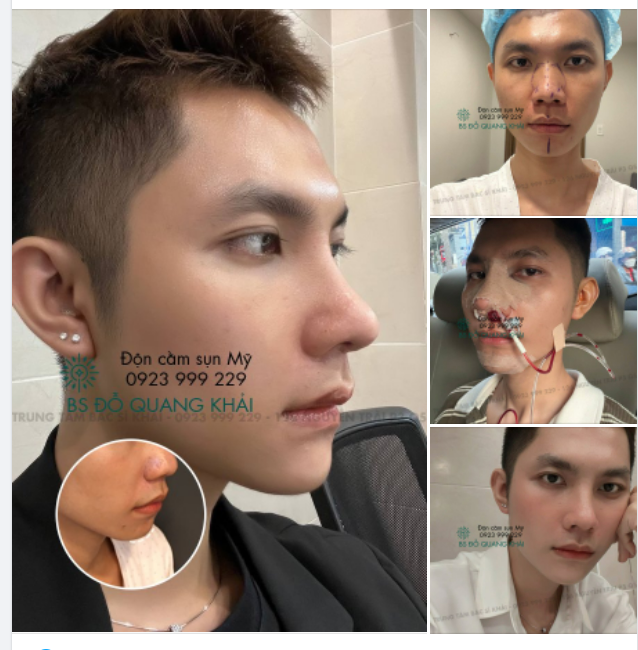 ĐỘN CẰM SIÊU ƯU ĐÃI THÁNG 5 ĐẶT LỊCH NGAY