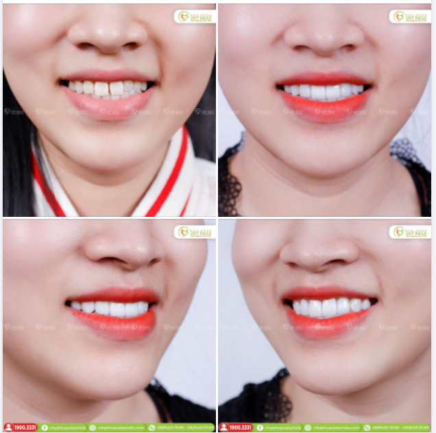 ĐÓNG KHE THƯA RĂNG VỚI DÁN SỨ VENEER