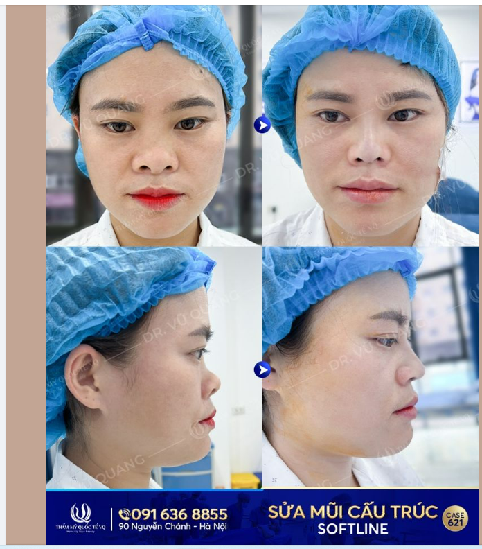Dr Vũ Quang Tái sinh mũi hỏng - Vực dậy niềm tin - Ưu đãi 30% chỉ còn 35tr - Tặng thêm 5tr tiền mặt.