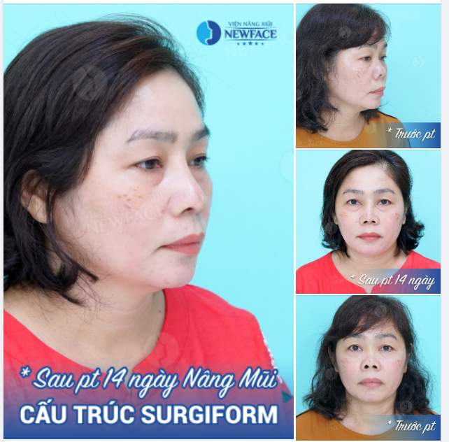 Dù Mũi “Biến Dạng”, Chị Ấy Vẫn Không Ngừng Hy Vọng