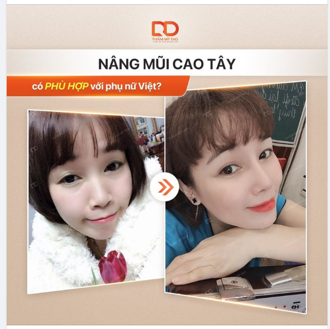 Dùng cả thanh xuân chỉ để lựa chọn Nâng mũi tự nhiên hay cao tây.