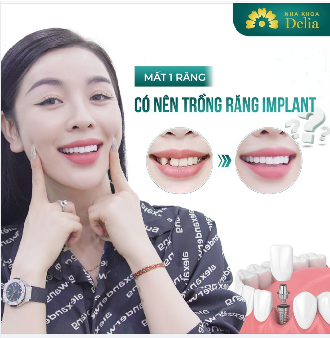 Đừng chủ quan dù chỉ mất 1 răng!