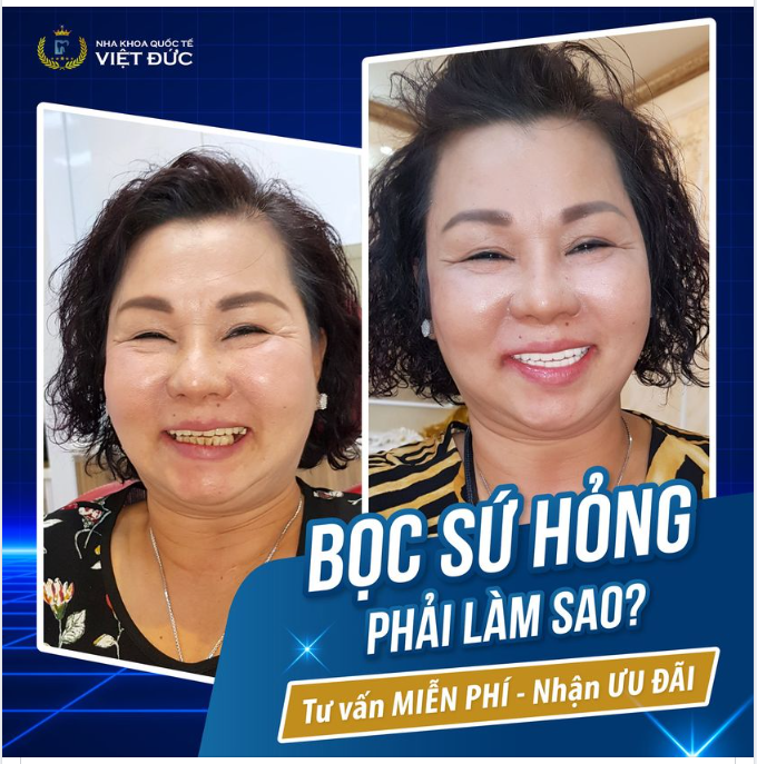 Đừng lo lắng, đến ngay Nha Khoa quốc tế Việt Đức nhé!