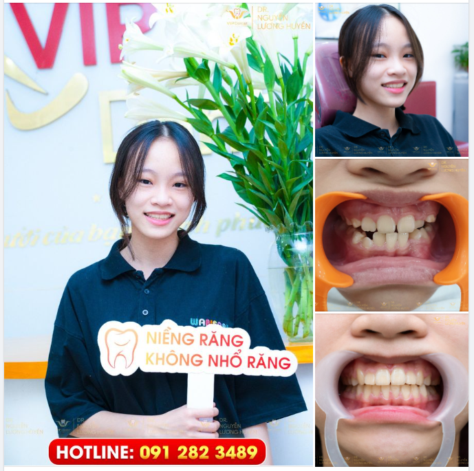DỨT ĐIỂM RĂNG KHẤP KHỂNH NẶNG, MỌC NGOÀI CUNG HÀM CHỈ SAU 6 THÁNG NIỀNG RĂNG