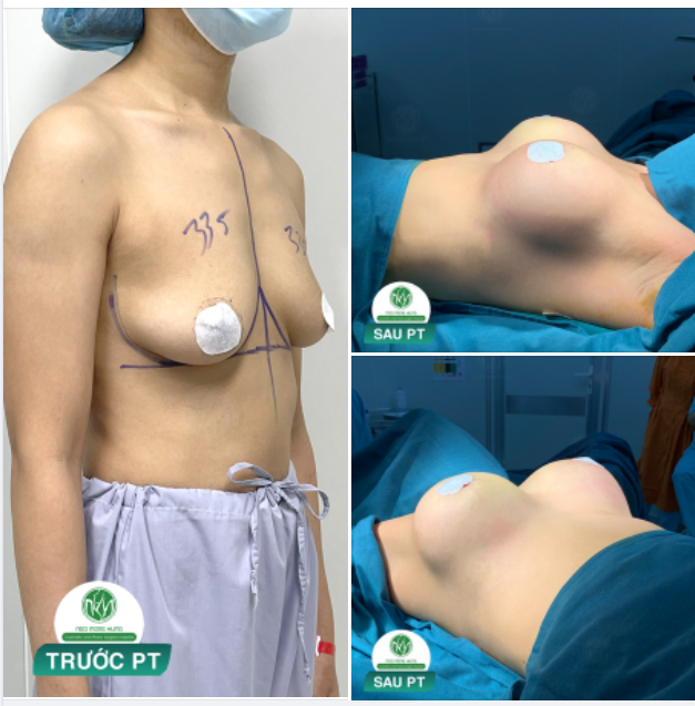 Em từ nước ngoài về làm ngực chỉ vì muốn được bác làm cho, tin tưởng bác rất nhiều ...