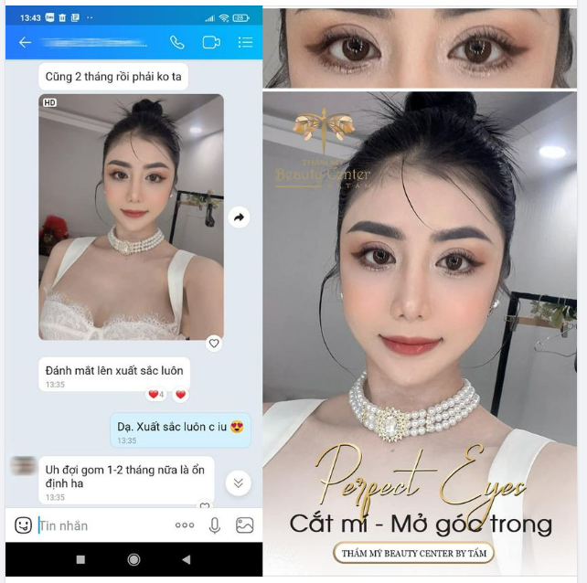 Feedback COMBO Cắt mí mở góc trong Perfect Eyes sau 2 tháng của khách hàng tại Thẩm mỹ Beauty Center by Tấm
