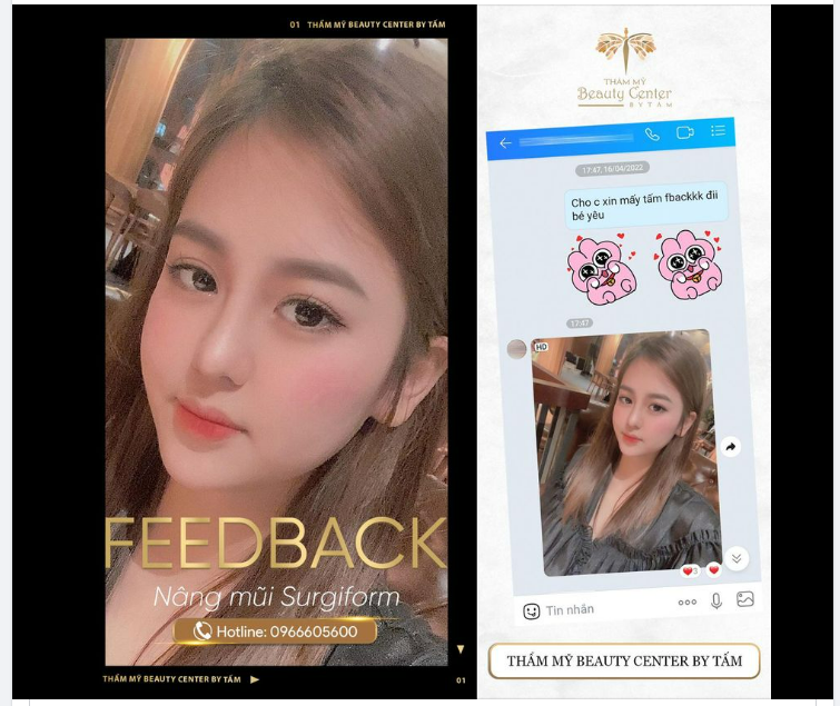 Feedback của khách hàng xinh lung linh sau khi nâng mũi Surgiform tại Thẩm Mỹ Beauty Center By Tấm