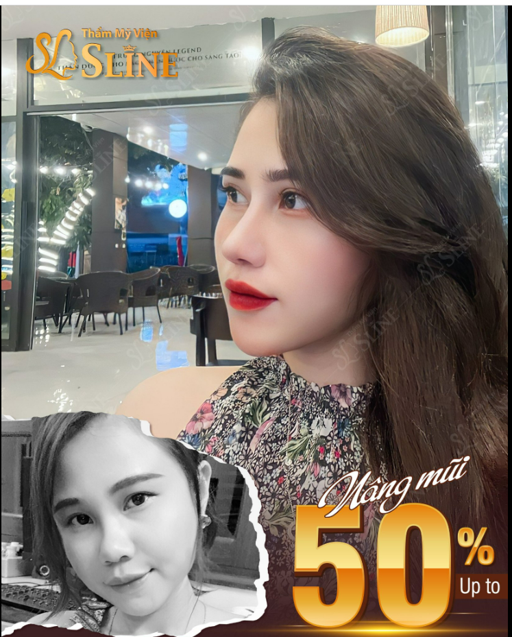 Feedback mỗi ngày! Hình ảnh khách hàng trước và sau khi nâng mũi.