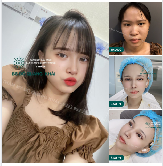 Feedback MŨI SIÊU CẤU TRÚC - CẮT MÍ - MỞ GÓC MẮT TRONG sau 8 tháng tuổi của khách hàng BÁC SĨ KHẢI