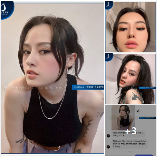 FEEDBACK Mũi tái cấu trúc sửa lại sau 2 tháng