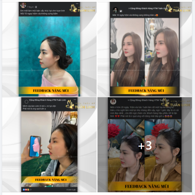 FEEDBACK NÂNG MŨI Tại sao khách hàng lại tin tưởng lựa chọn VTM Tuấn Linh để làm đẹp.