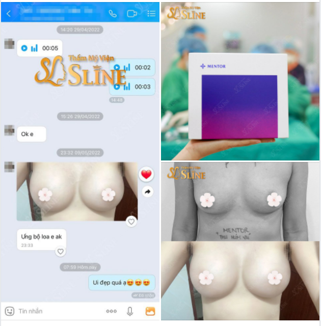 Feedback Ngực 1 tháng tuổi.
