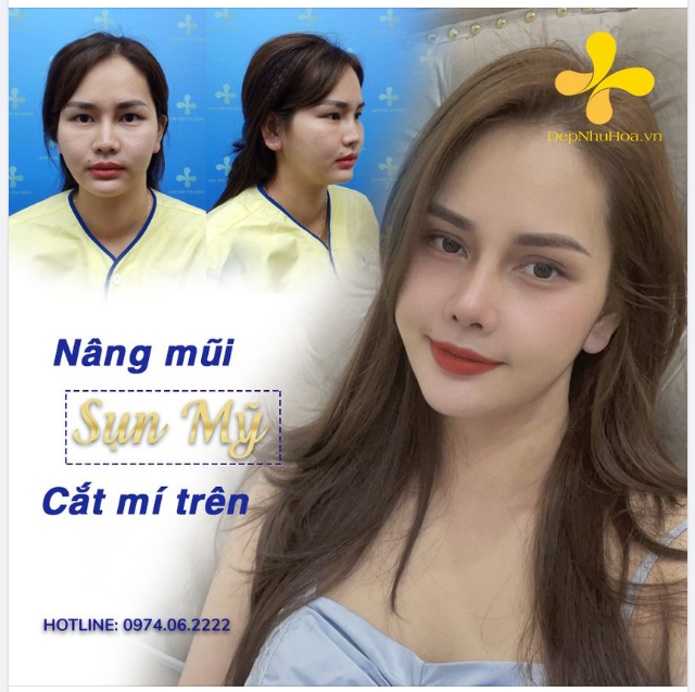 Feedback siêu chân thực từ khách xinh. Cùng Combo CẮT MÍ VÀ NÂNG MŨI CAO XINH - GÓC NÀO CŨNG LUNG LINH