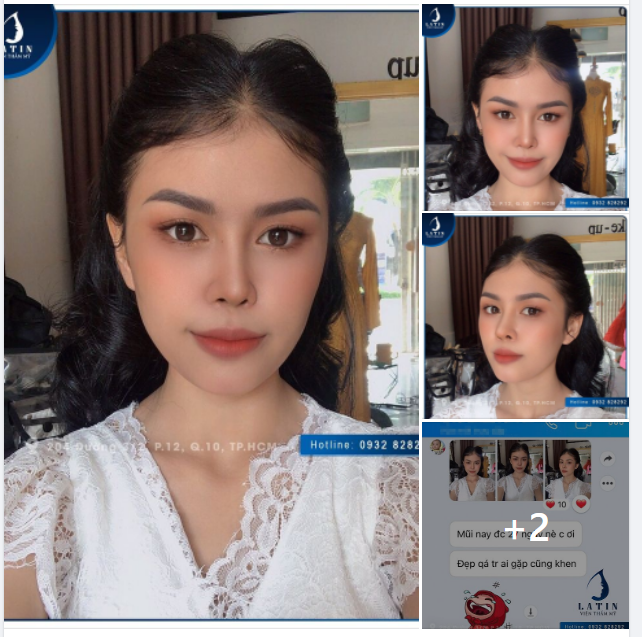 Feedback Thần thái hoàn toàn mới của khách hàng sau gần 1 tháng nâng mũi tại LATIN.