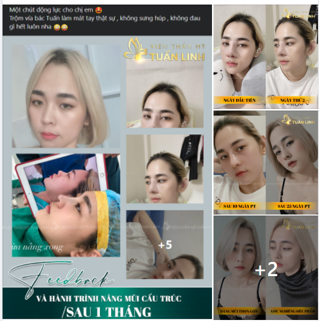 FEEDBACK VÀ HÀNH TRÌNH NÂNG MŨI SAU 1 THÁNG CỦA CÔ NÀNG 9X XINH ĐẸP.
