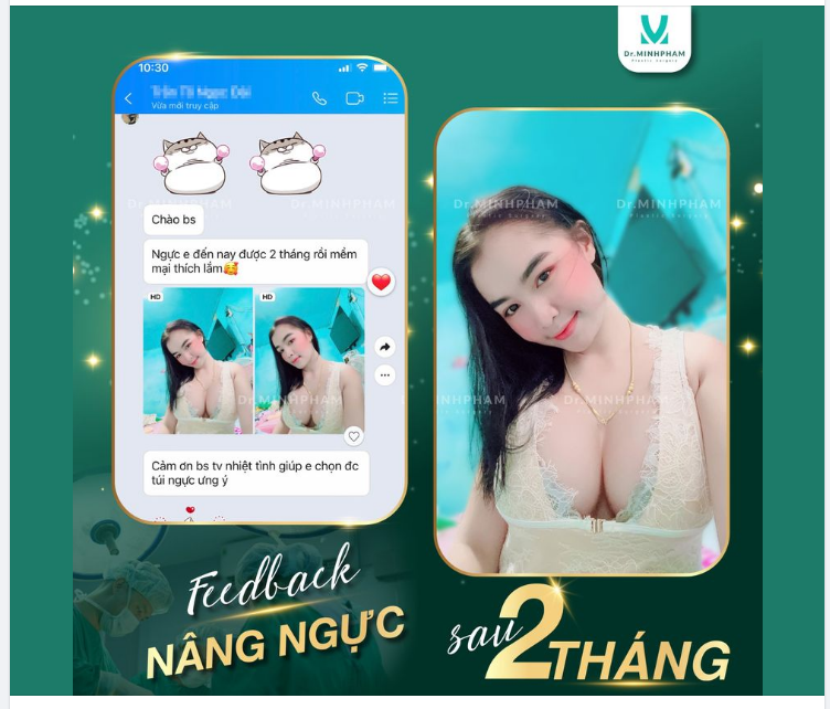 Feedback nâng ngực Sebbin size 330cc sau 2 tháng.