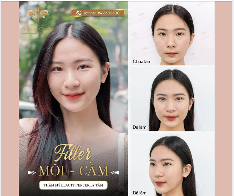 Filler - Giải pháp cho nỗi khổ sợ đau, sợ phẫu thuật