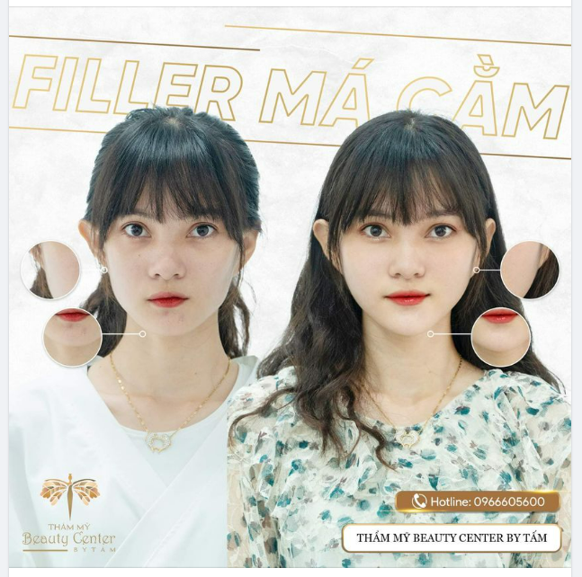 FILLER MÁ - CẰM BỘ ĐÔI HOÀN HẢO CHO CÁC NÀNG GẶP TÌNH TRẠNG