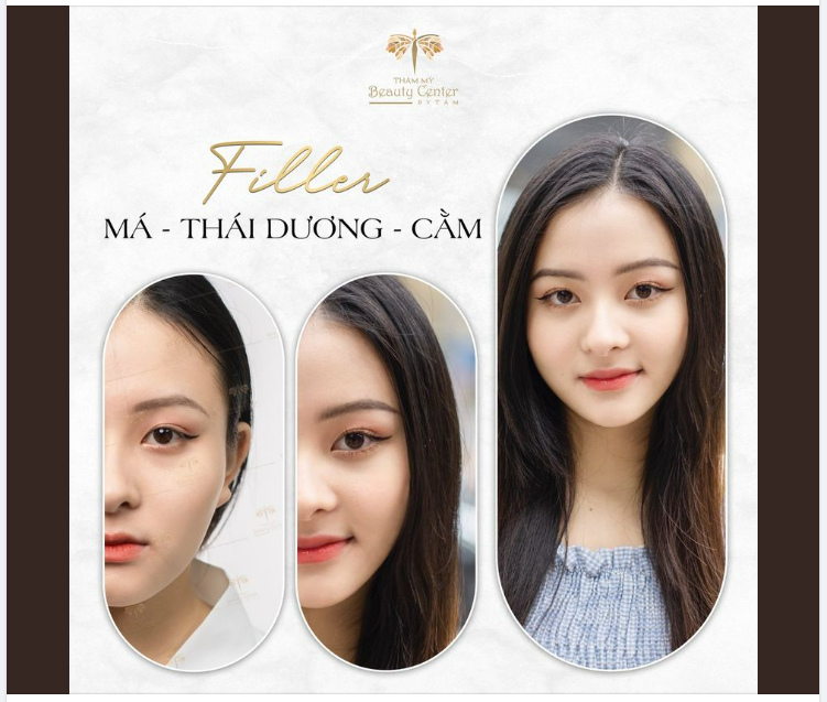 FILLER MÁ - THÁI DƯƠNG - CẰM COMBO HOÀN HẢO ĐỂ THĂNG HẠNG NHAN SẮC