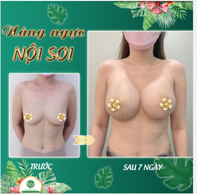 FORM NGỰC ĐƯỜNG QUẦNG V.Ú SAU 7 NGÀY