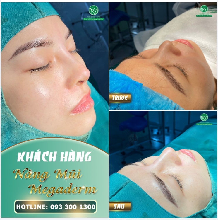 GIẢI CỨU CHIẾC MŨI THẤP - TẶNG BẠN DÁNG MŨI CAO DÀI LÂU