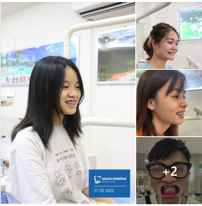 Giải mã sức hút của niềng răng mắc cài kim loại mùa hè này