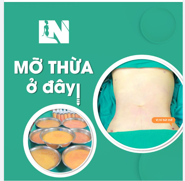 GIẢI PHÁP SIẾT VÒNG EO THON GỌN SAU 2 GIỜ - MỠ THỪA ĐI ĐÂU